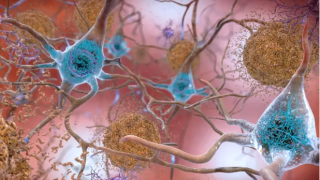 A Breakthrough in Curing Alzheimer’s Disease